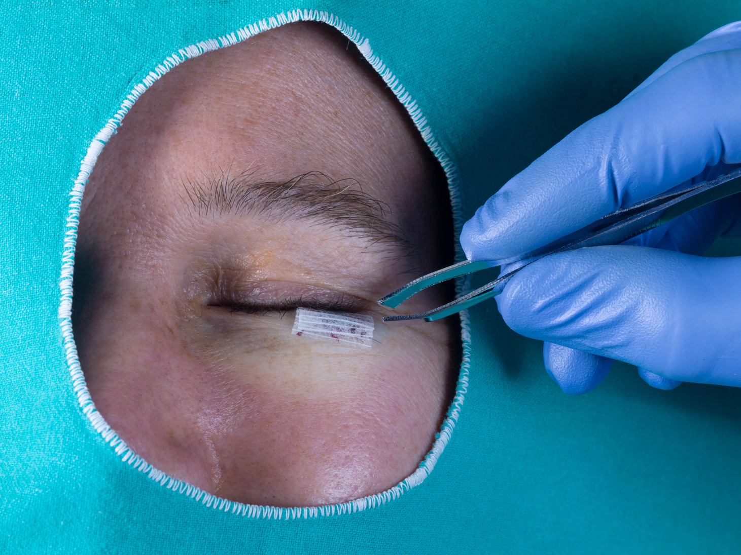 Surgery on the lower eyelid