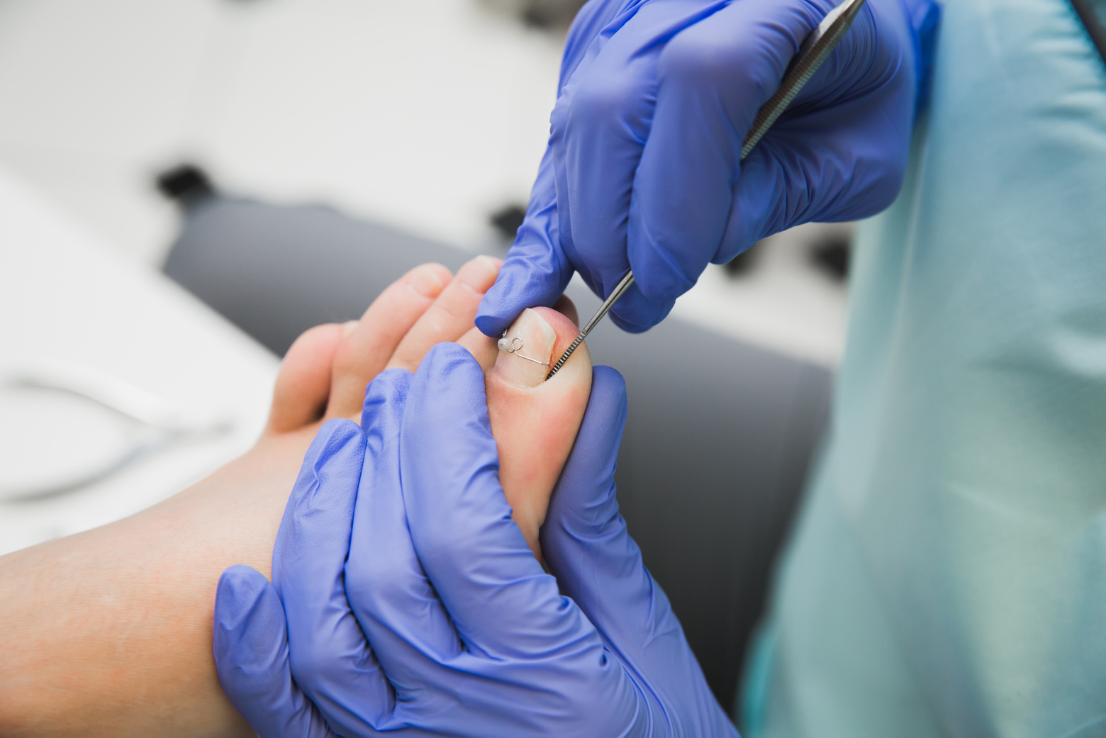 Nail clip. A podiatrist treats an ingrown toenail. Medical pedicure procedure. Orthonyx Bracket